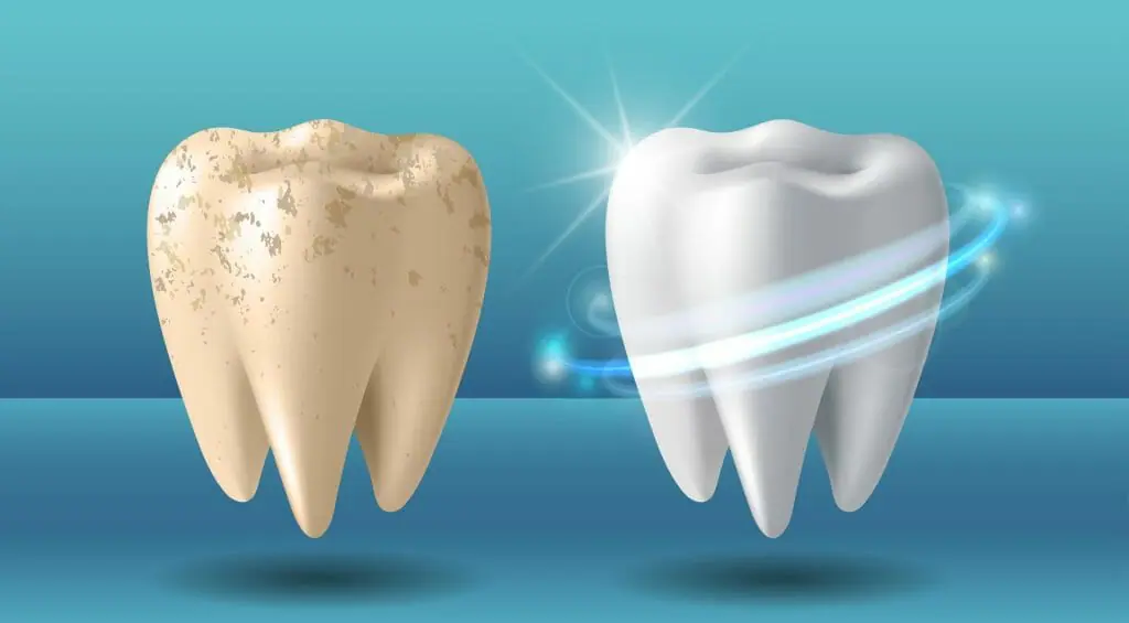راهکار جرم گیری دندان و سفید کننده دندان ها