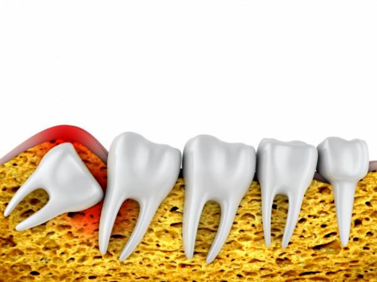 مراقبت‌های مهم بعد از کشیدن دندان عقل