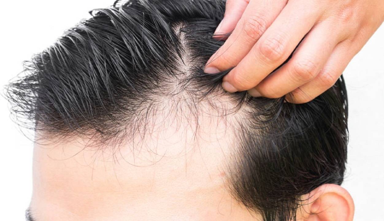 8 روش درمان طبیعی ریزش موی زنان و مردان در قسمت شقیقه ها
