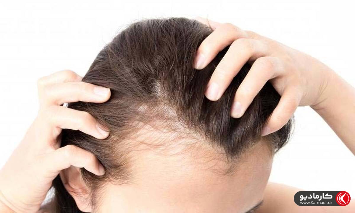 8 ترفند عالی درمان ریزش مو شقیقه مخصوص مردان و زنان