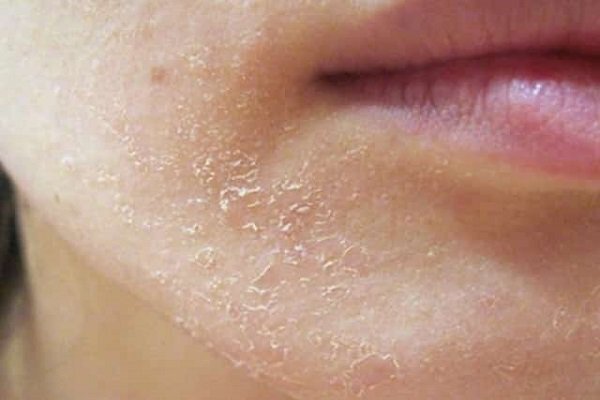 پیشگیری از بروز خشکی پوست