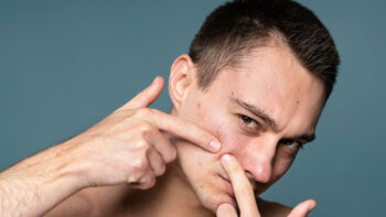 علت جوش صورت در مردان و بهترین روشهای درمانی آن