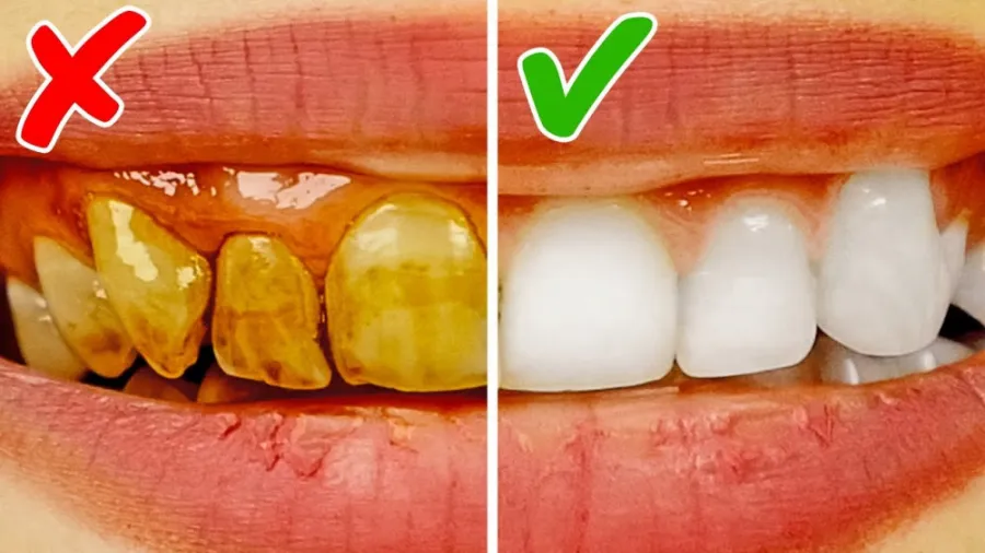 روش‌ های طبیعی برای سفید کردن دندان‌ ها در خانه