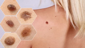 علائم اولیه سرطان پوست (انواع و روش های درمان و عوارض آن)