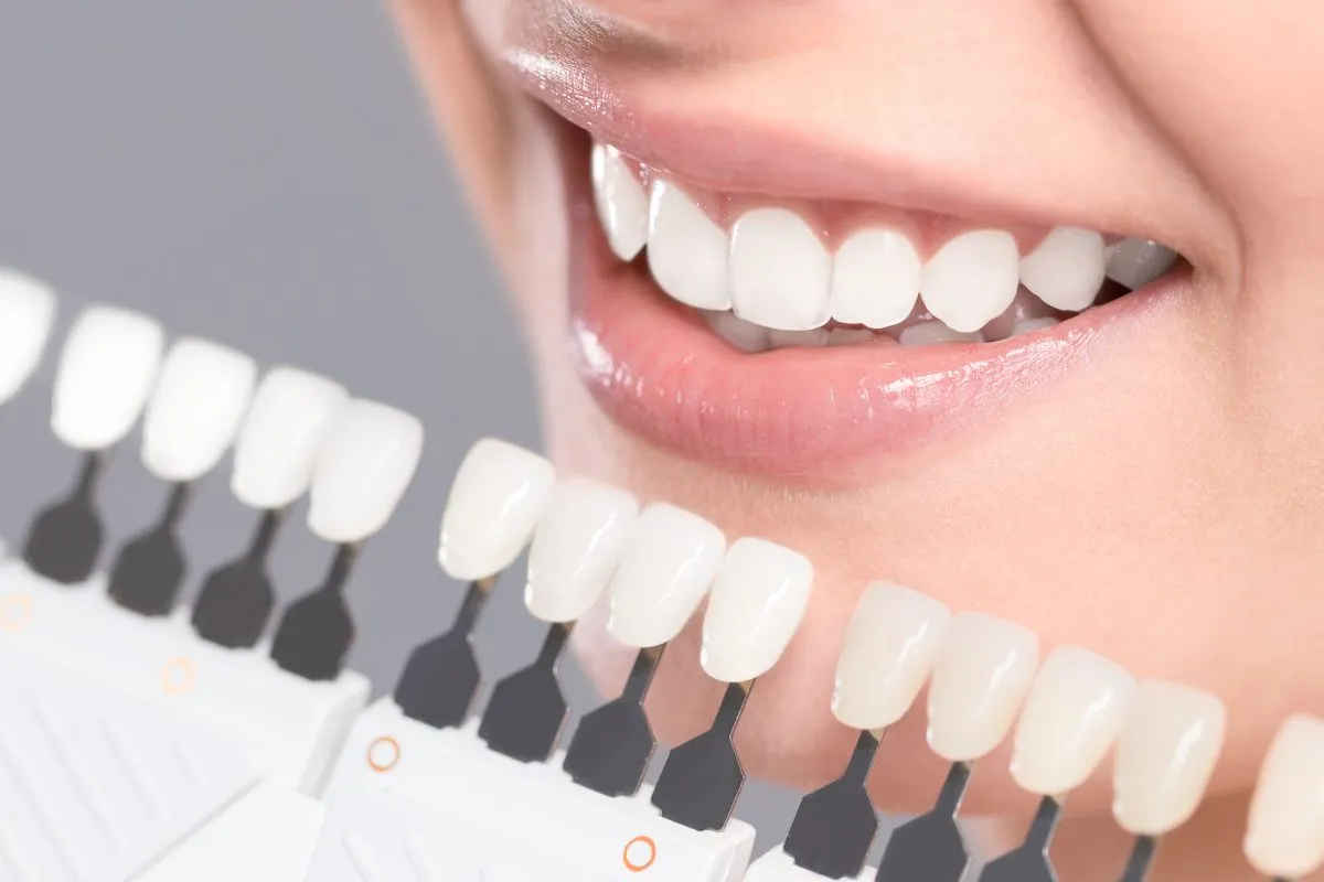 لمینت و کامپوزیت دندان چیست؟ (تفاوت انواع سفید کردن دندان)