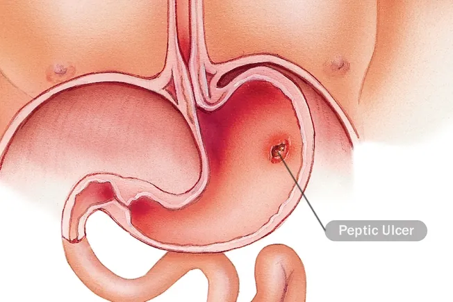 درمان زخم معده