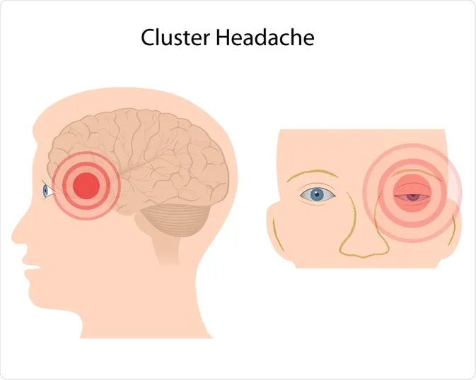 سردرد خوشه‌ای چیست؟ علائم و درمان