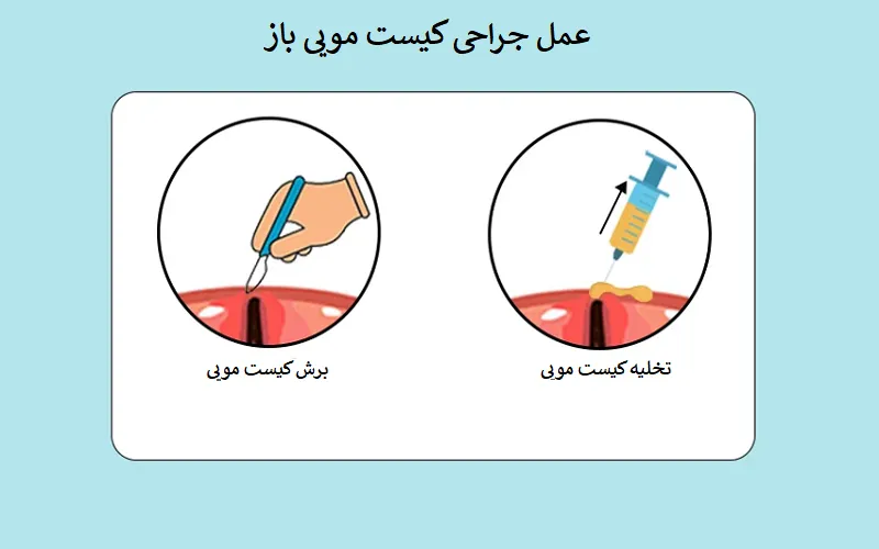 قبل و بعد از جراحی کیست مویی چه کنیم؟ {عوارض عمل نکردن آن}